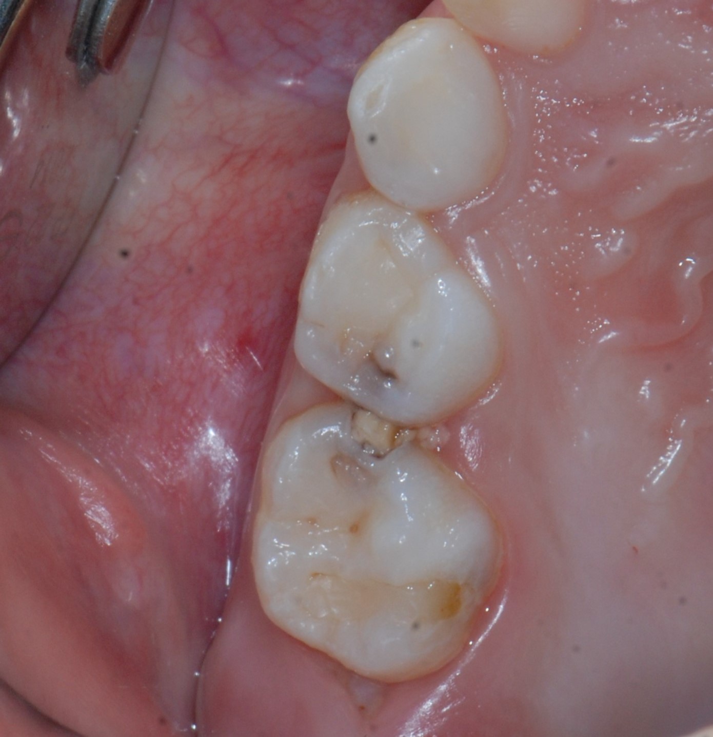 小朋友塞牙,小朋友的塞牙反复发作