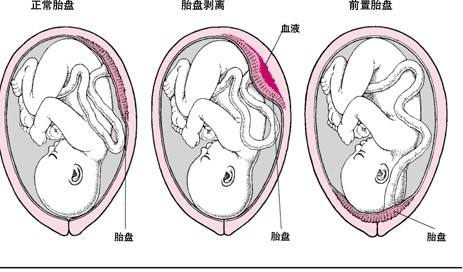 孕12周胎盘低置有宫腔积液怎么办,12周孕妇b超显示胎盘低置有危险吗