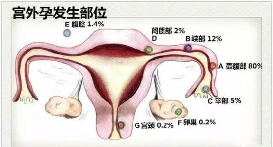 宫外孕肚子疼女孩死亡,女友宫外孕我该怎么办