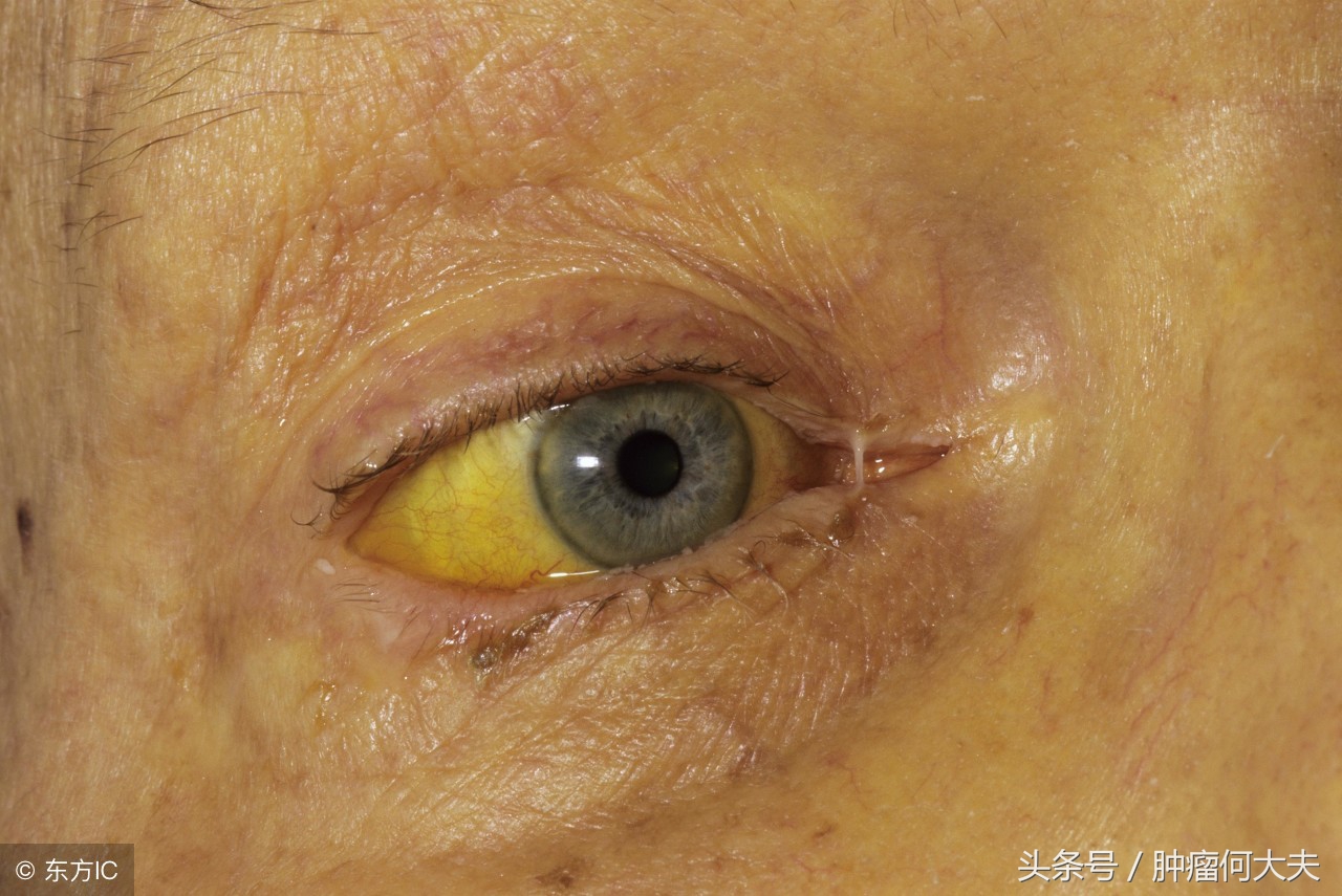 请问胰腺癌早期是什么症状啊,癌中之王胰腺癌怎么筛查