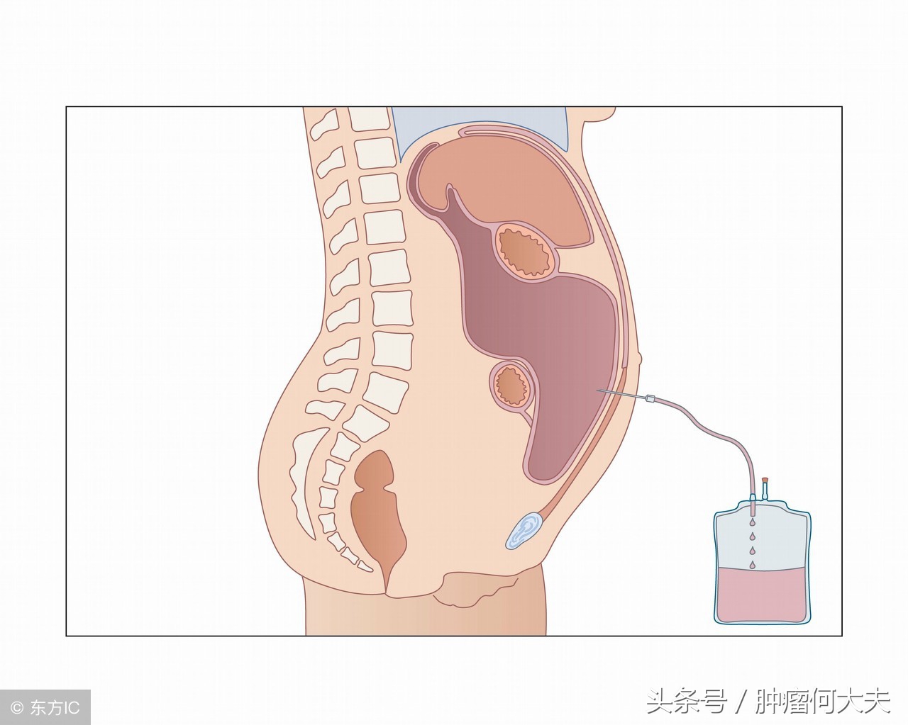 肿瘤晚期腹水怎么消除,癌症晚期腹水腹腔穿刺