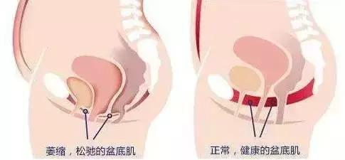 子宫脱垂小便出血严重吗,子宫脱垂与白带多有关吗