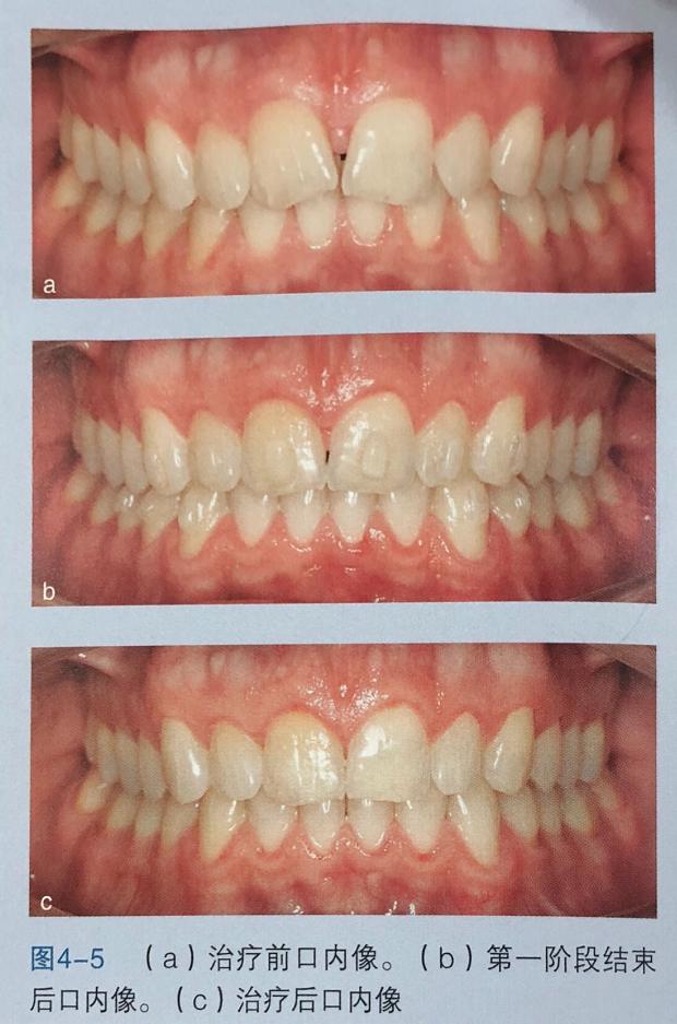牙齿上的黑三角怎么回事,牙齿上的黑三角怎么改善