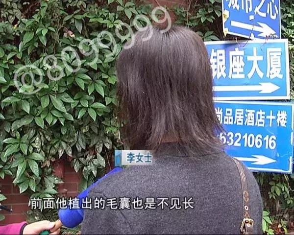 女子植发然后全部脱发,女子斑秃治疗后全秃