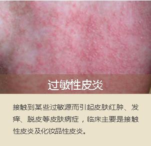 面部脂溢性皮炎辨别图片,面部脂溢性皮炎怎么治