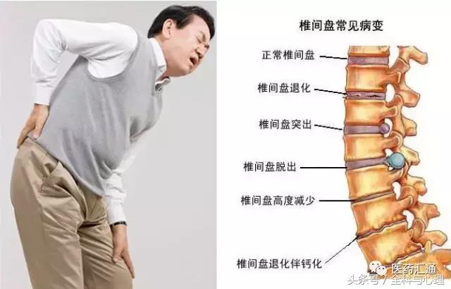 怎么预防腰椎间盘突出复发,腰椎间盘突出症预防方法宣教