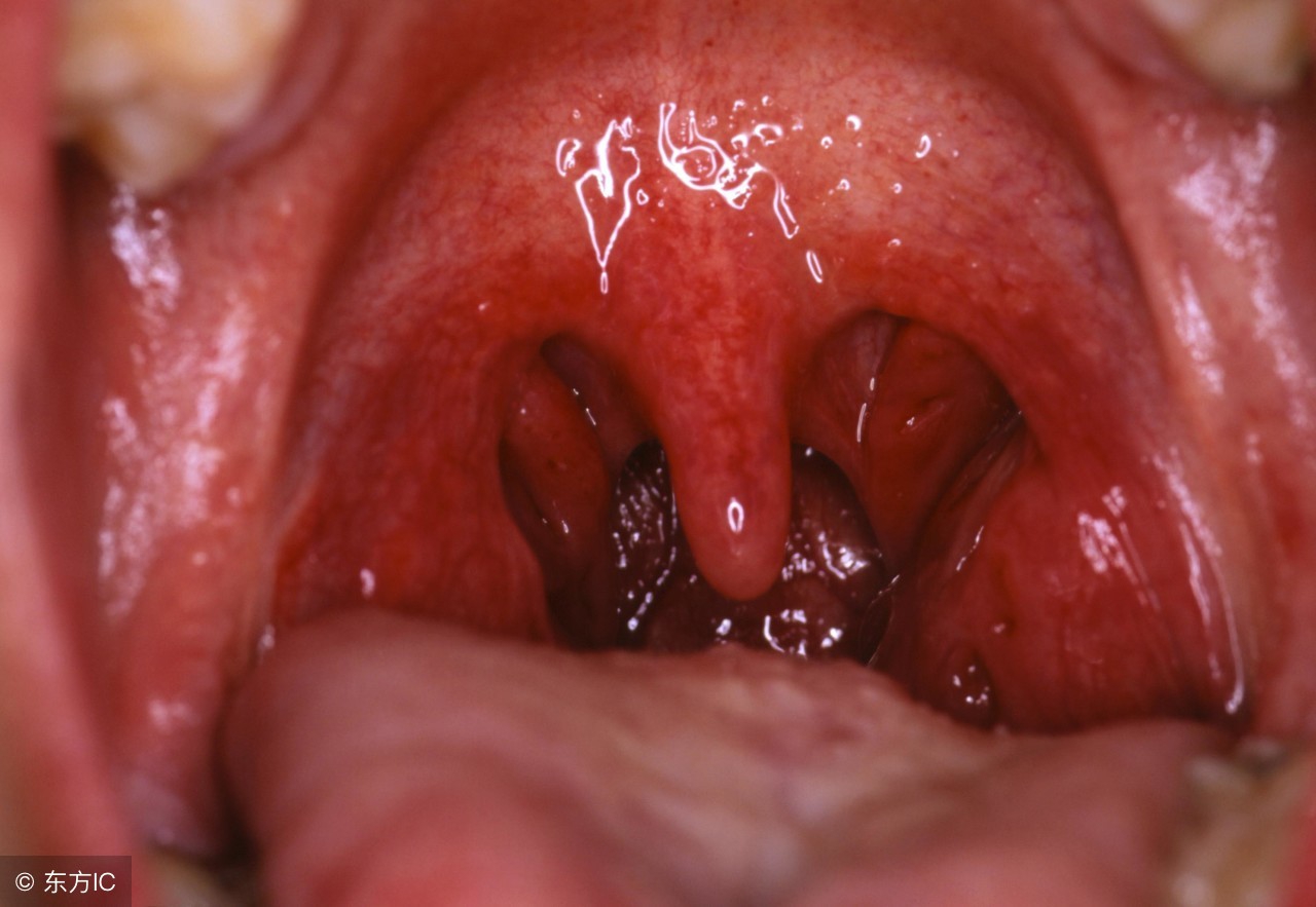 咽干咽痒咳嗽痰多多久自愈,咽干咳嗽有黄脓痰但咳不出来