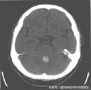 脑出血李医生,脑出血病例分析及答案