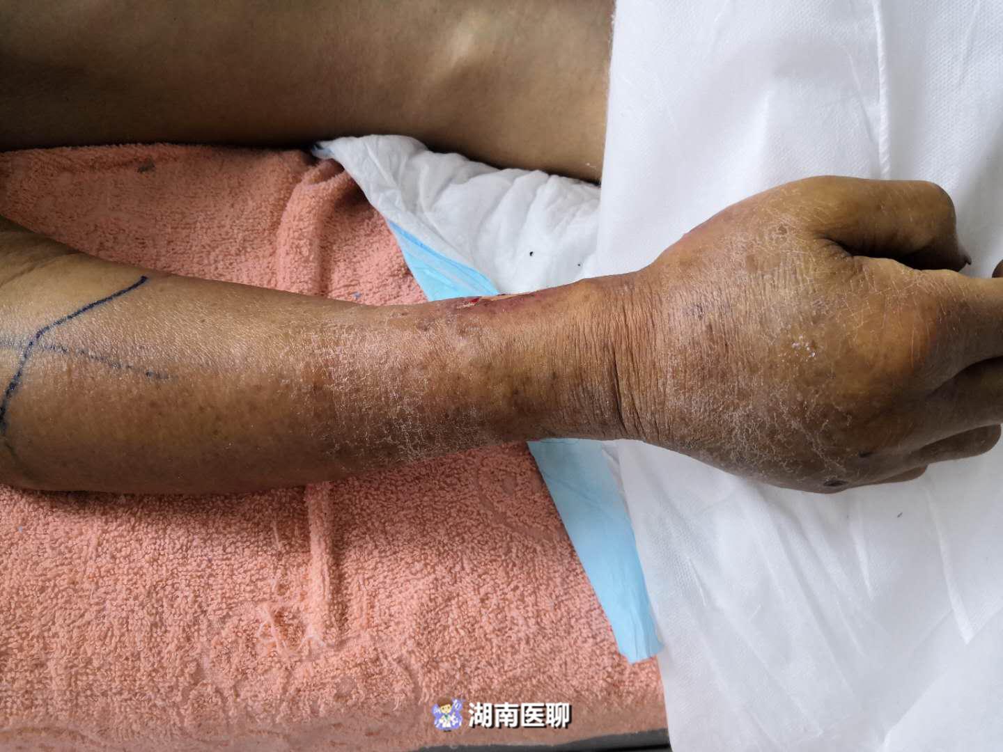 农村小伙摘菜被虫咬,湖南六旬老人被虫子咬了一口