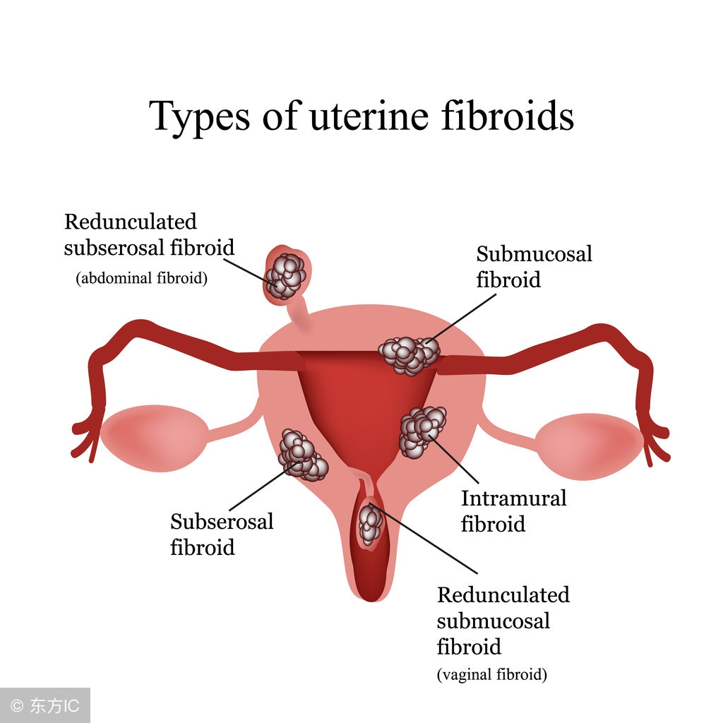 子宫肌瘤继发感染和变性哪个严重,子宫肌瘤继发变性有哪几种