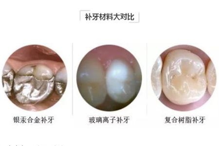 树脂补牙什么意思,树脂补牙是什么原因引起的