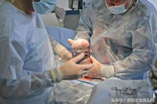 女人一共可以剖腹产几次,女人一生可以几次剖腹产