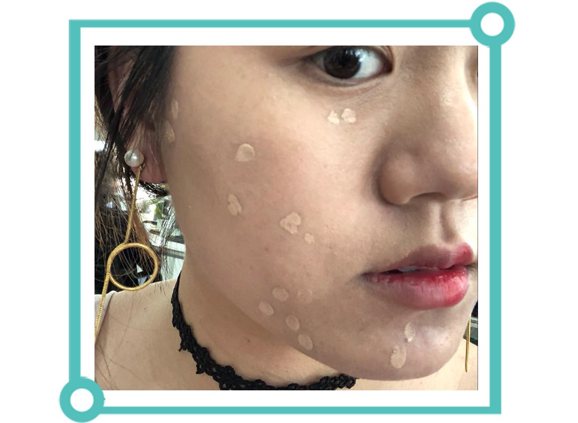 怎样消除痘印食疗,青春期痘印怎么消除小妙招