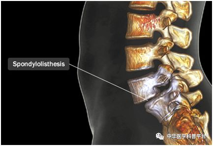 左腰背部疼痛是什么原因引起的,湿气重会腰背部疼痛吗