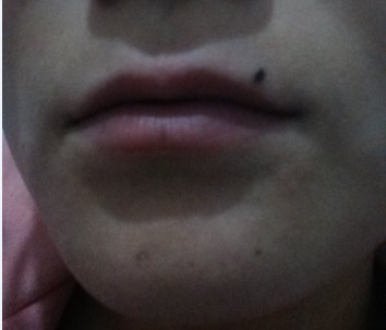 嘴上一个黑痣,嘴上有一颗很大的痣去掉后的图