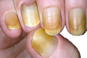 怎么从指甲上看健康图解,从指甲看疾病的图片说明