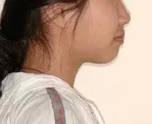 矫正牙齿可以变美吗,矫正牙齿后变美更自信