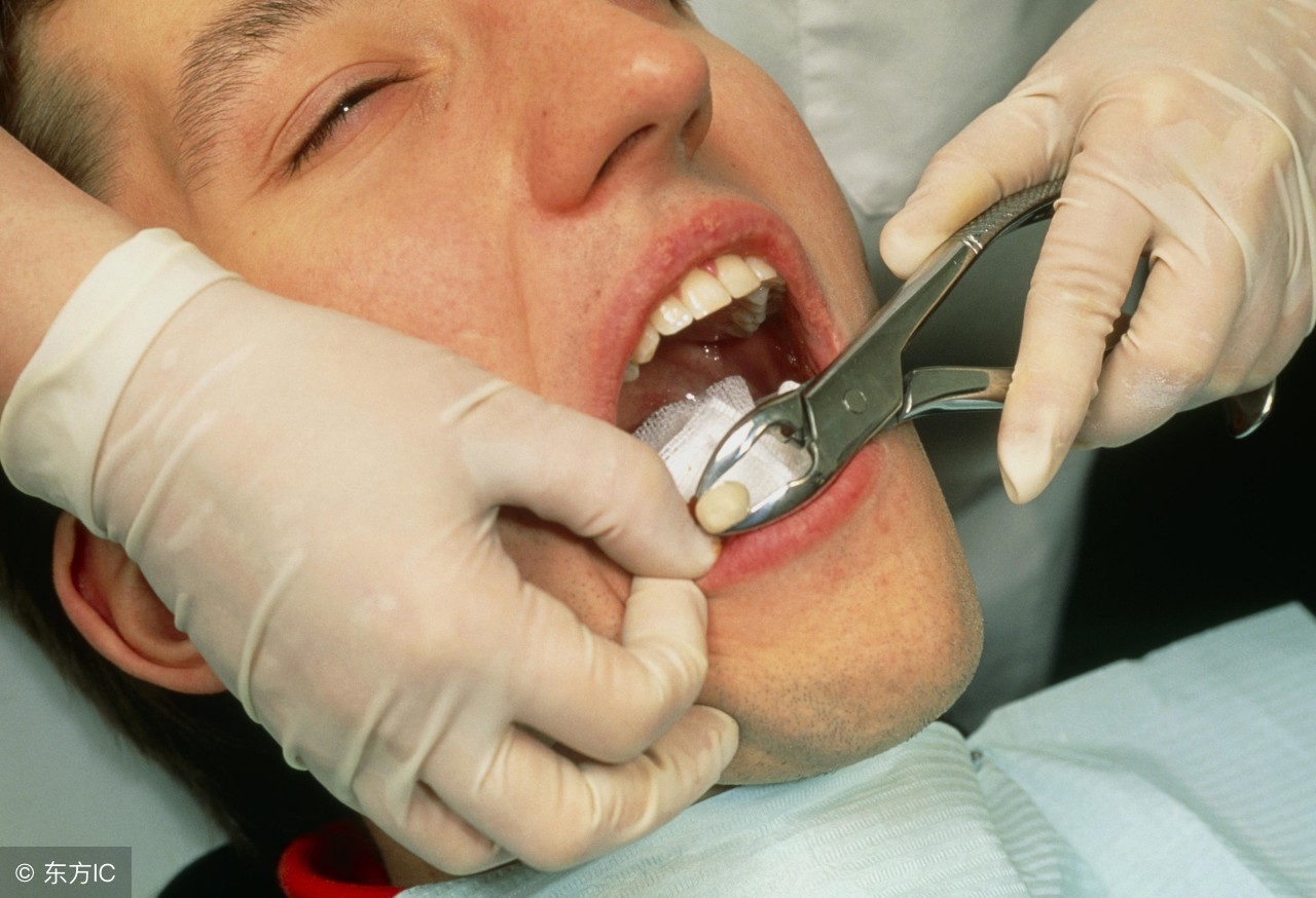 拔智齿后牙洞愈合期间注意事项,拔智齿后吃东西需要注意什么