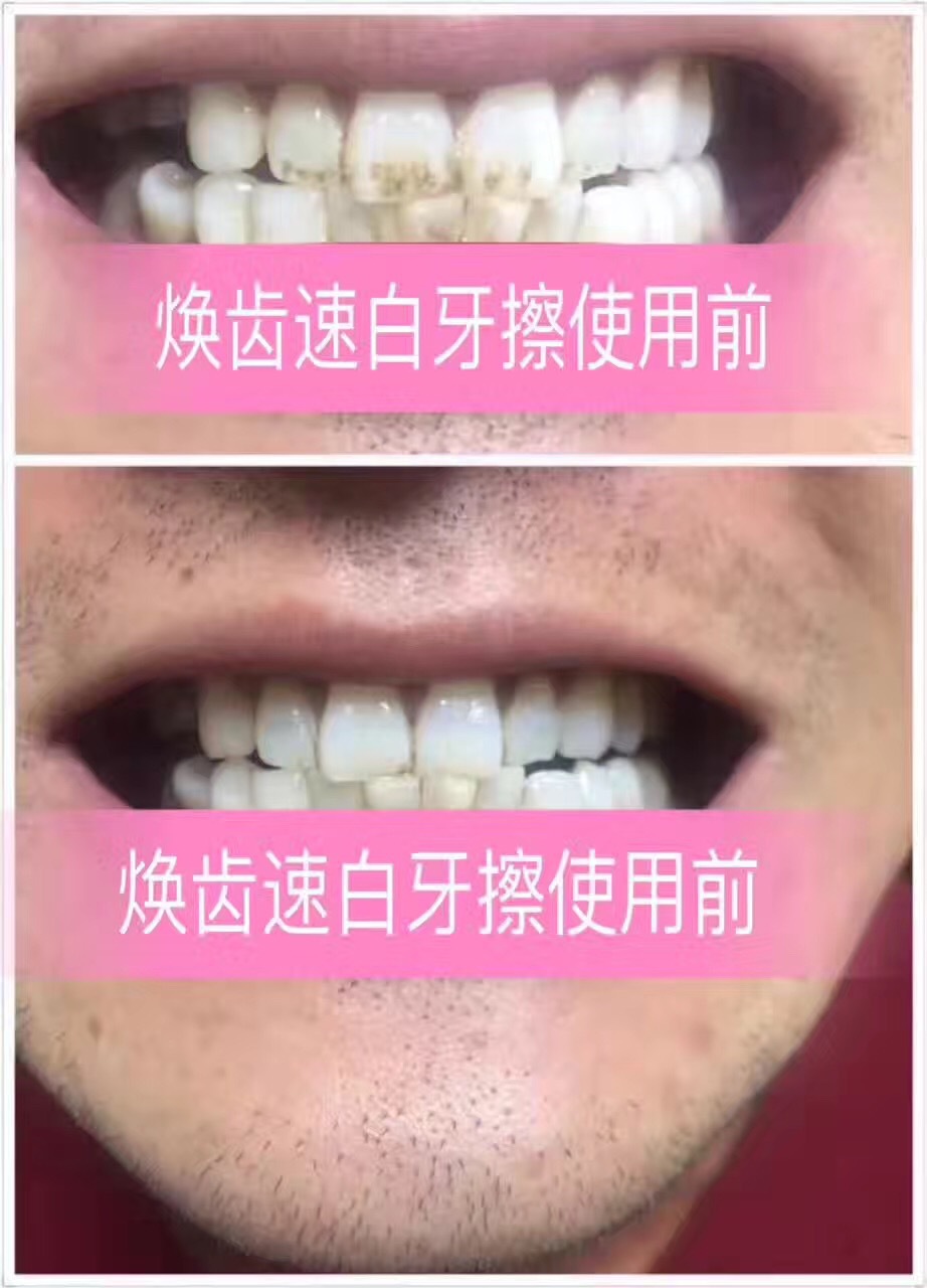 牙齿美白速效去黄牙烟渍神器,清洁牙渍美白牙齿