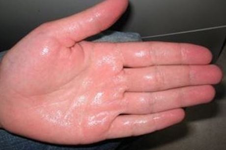 爱出汗是什么原因和治疗,频繁出汗的原因三种病