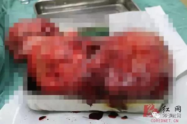 巨大子宫肌瘤手术取出3斤,罕见医生从女子胆囊取出巨大结石