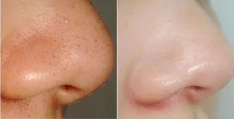 有效去黑头的方法小妙招,6个快速有效去黑头的小妙招