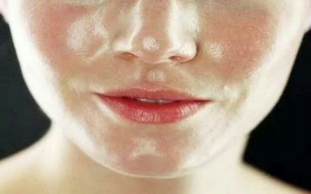 全是螨虫教你一招除螨,有螨虫用什么方法去螨最好