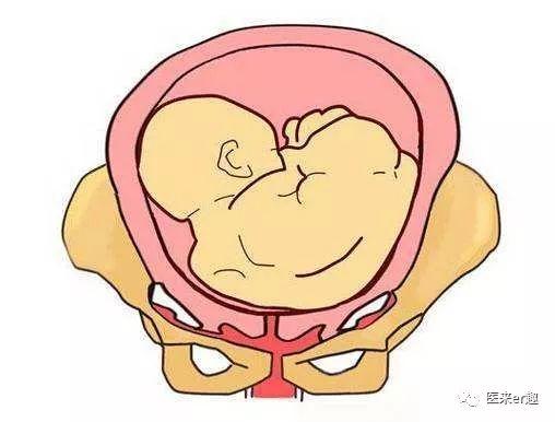 胎位不正是小孩畸形吗,胎位不正怎么顺产