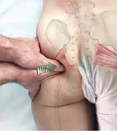 坐骨结节与坐骨神经解剖,坐骨神经结节痛治疗最好的方法