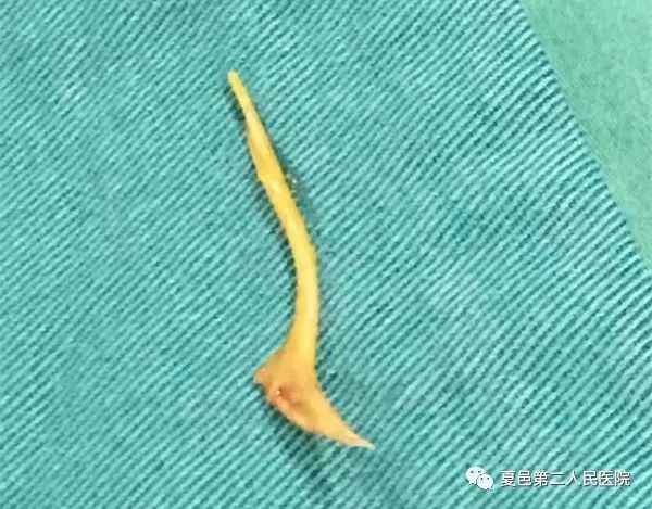 腹部烧灼样疼痛怀疑哪些疾病,腹部疼痛如何排除阑尾炎