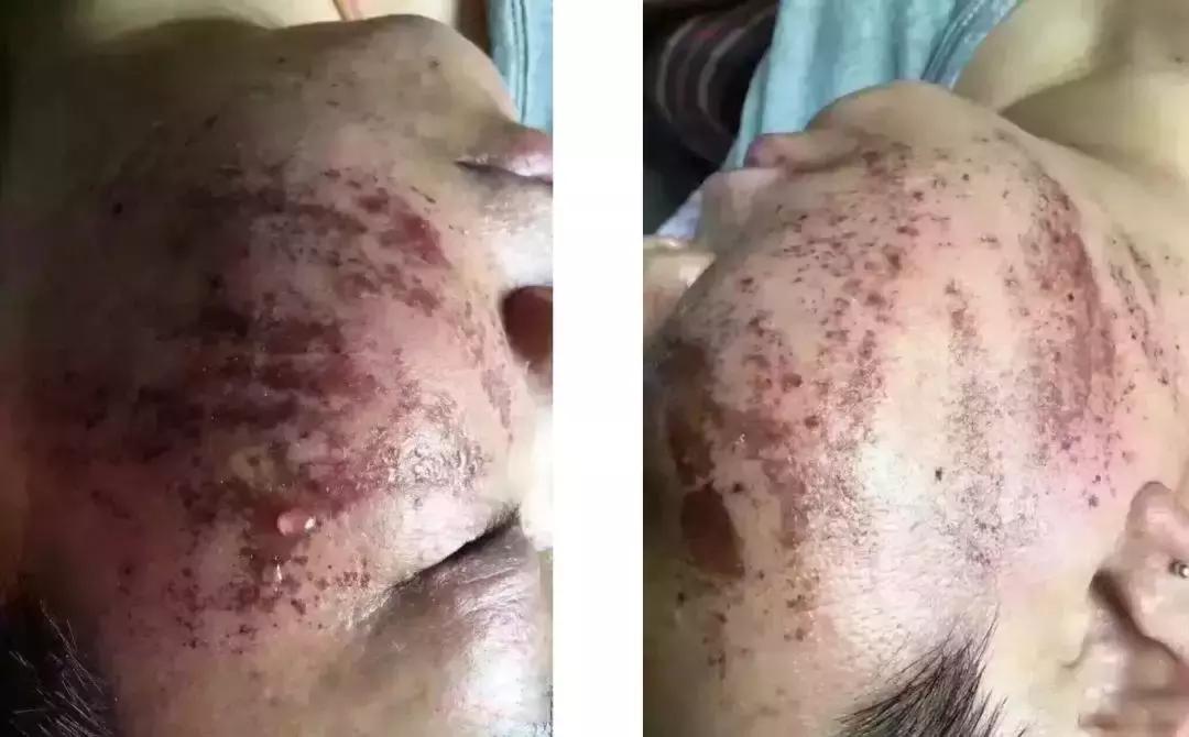 几千块钱做的超声刀，想要逆龄反被毁容？！