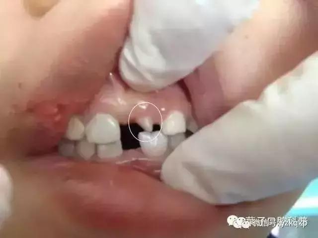 口腔科普儿童换牙常识,儿童换牙后牙缝大需要做矫正吗