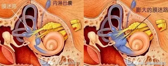 梅尼埃病是先天性疾病吗,梅尼埃病是谁发现的