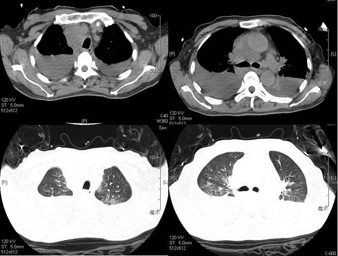 抗核治疗后反而病情加重？这个病例太经典了！