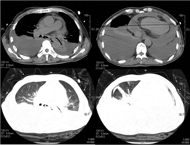 抗核治疗后反而病情加重？这个病例太经典了！