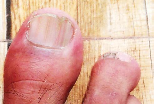 脚趾甲发绿图片,如何判断脚趾甲变色