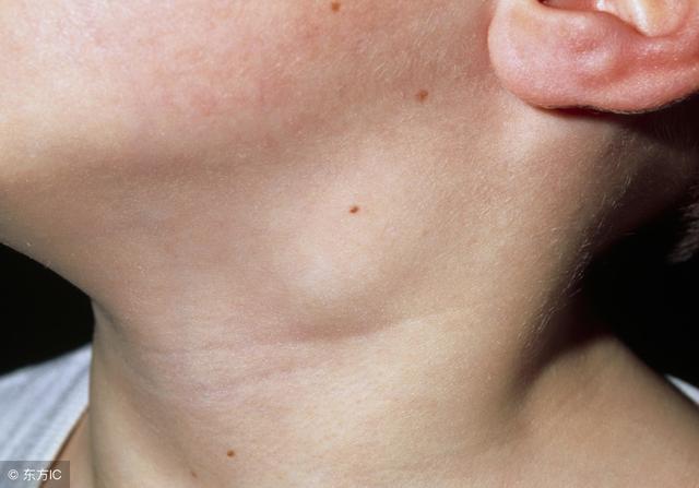 得了淋巴癌最长能活多久,为什么会得淋巴癌一般能活多久