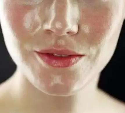 螨虫在脸上会吃成坑吗,螨虫吃进肚子里会怎样