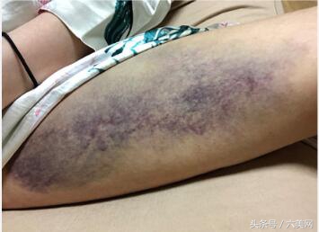 隆鼻后如何克服焦虑,隆鼻后前三天状态