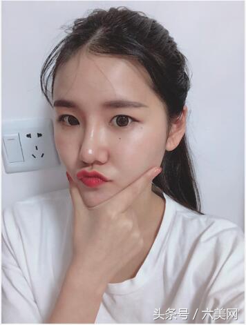 隆鼻后如何克服焦虑,隆鼻后前三天状态