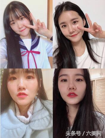 隆鼻后如何克服焦虑,隆鼻后前三天状态