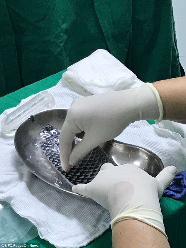 全球首例！巴西女子成功安装鱼皮阴道，已与男友开始幸福生活