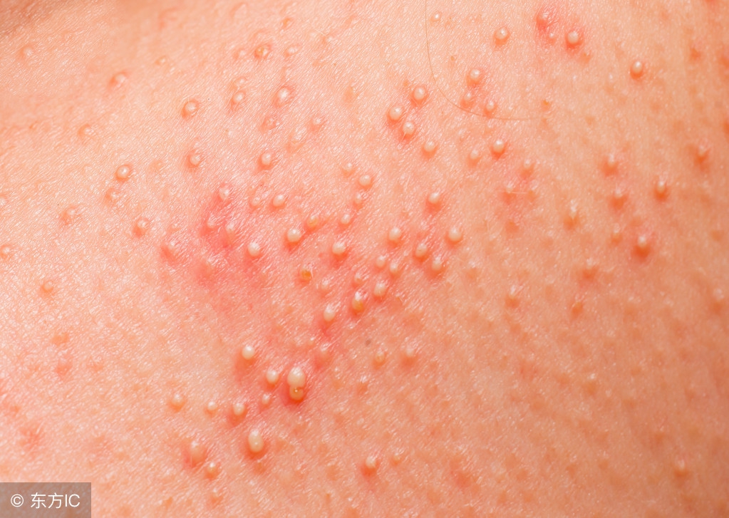 导致异位性皮炎的病因有哪些,异位性皮炎是什么样的症状