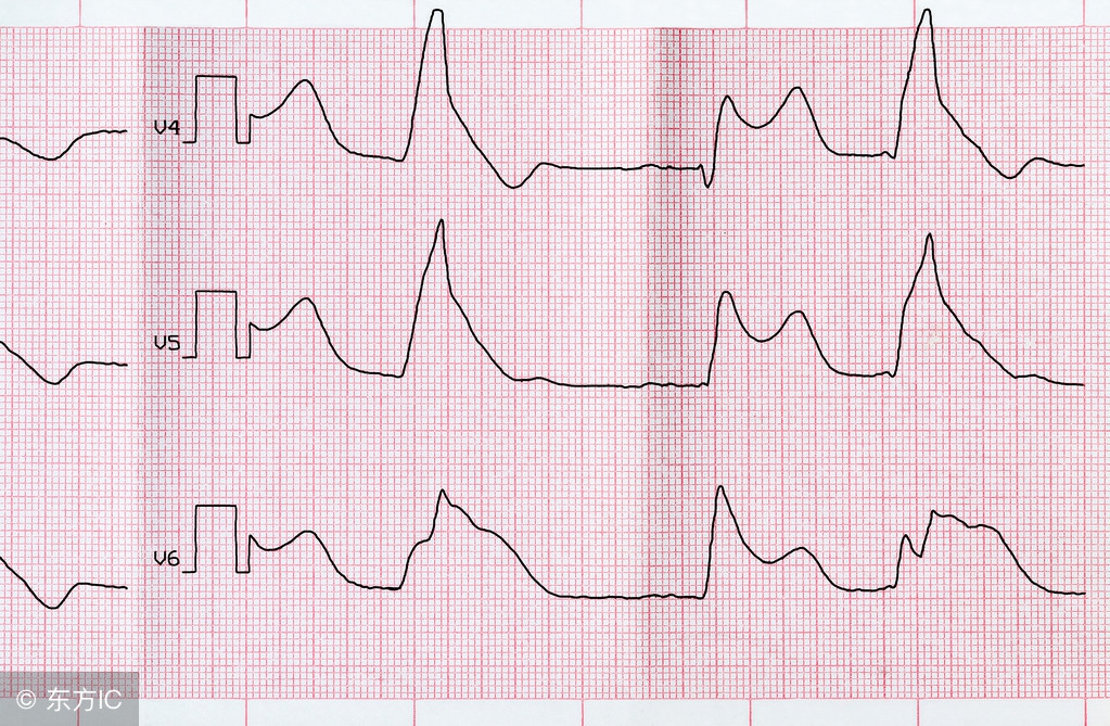 心脏早搏饮食要注意什么,心脏早搏饮食需要注意什么