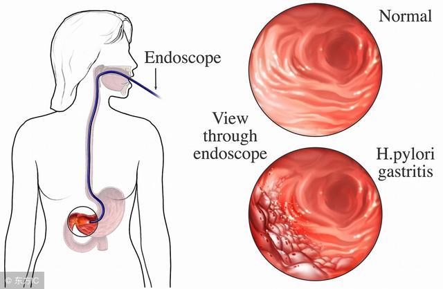 胃癌各临床分期治疗方案有哪些,胃癌怎么分期的