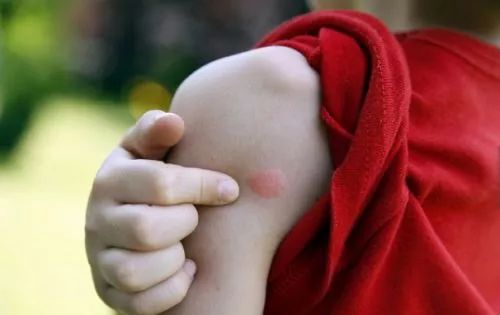 蚊子包越挠越扩散,蚊子包痒怎么快速止痒