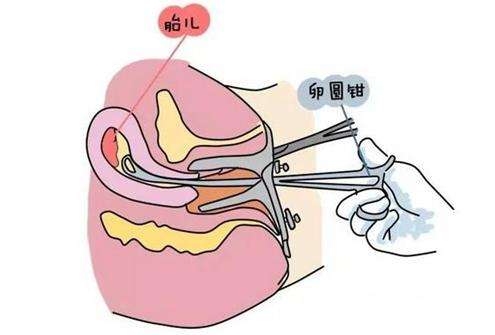 最安全的流产方法是什么,流产的三种类型