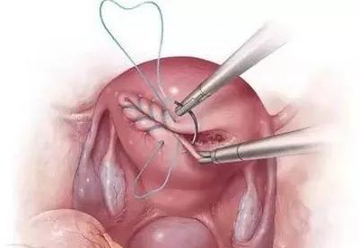 瘢痕子宫合并宫内早孕,瘢痕子宫单角子宫怀孕危险