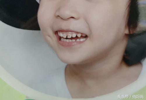 幼儿园为什么会有龋齿,小朋友为什么会有蛀牙幼儿园