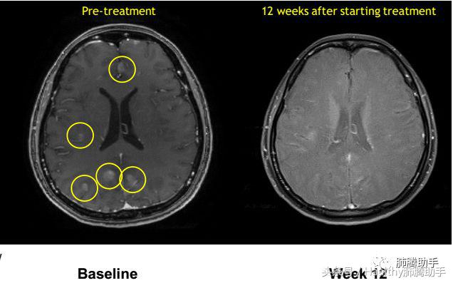 美国新上市的抗肺癌药物,asco抗癌新药